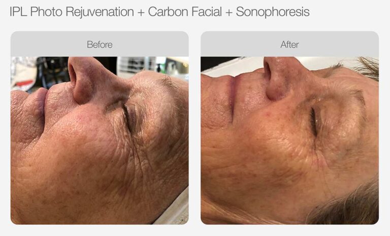 IPL+Carbon Facial+Sonophoresis Before after