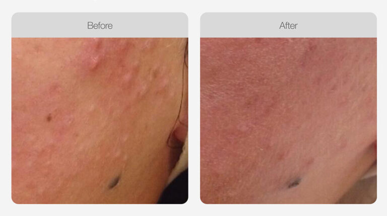 IPL_Acne_Management_Before_After_01