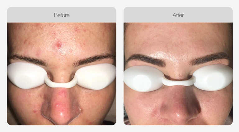 IPL_Acne_Management_Before_After_02