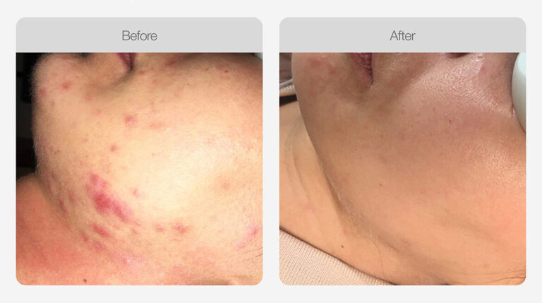 IPL_Acne_Management_Before_After_03