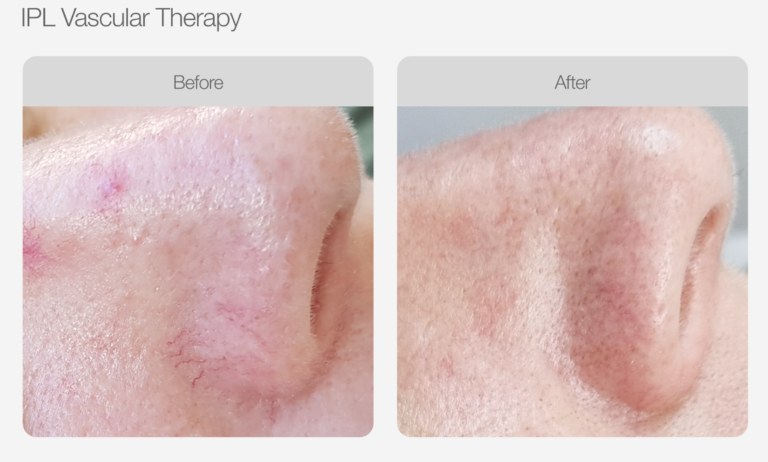 IPL_Vascular_Therapy_Before_After_ (2)