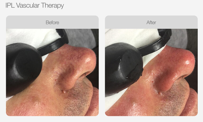 IPL_Vascular_Therapy_Before_After_ (3)